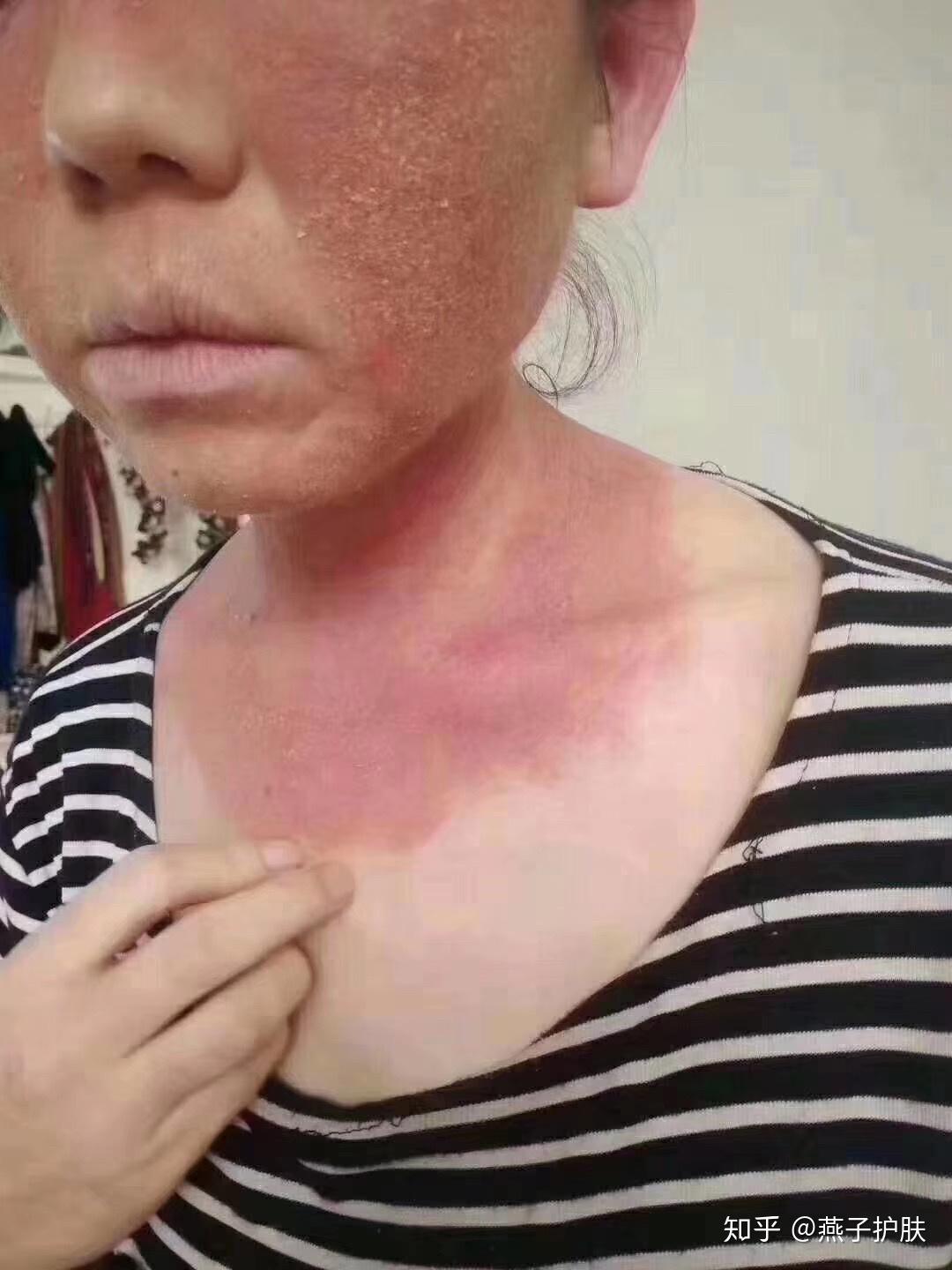 激素脸排异期间后期的症状是怎样的? - 知乎