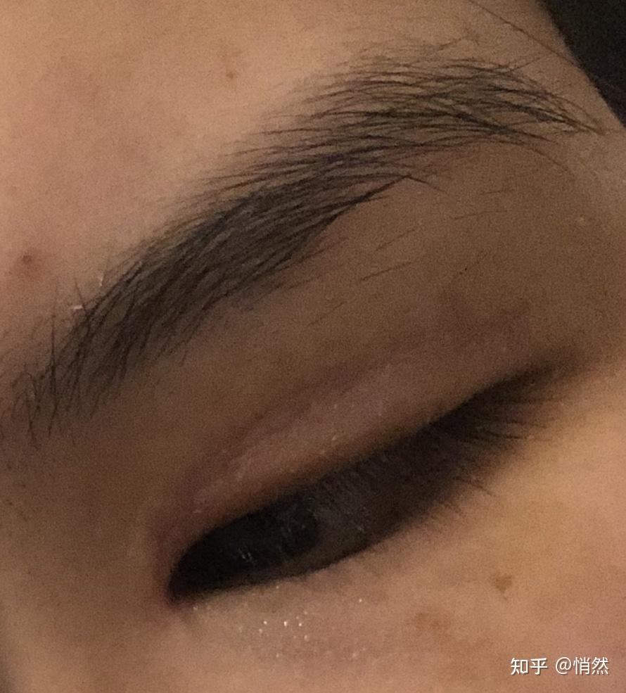 双眼皮术后15天褶皱和刀口不重合,眼尾分出两道痕迹,自己可以做什么