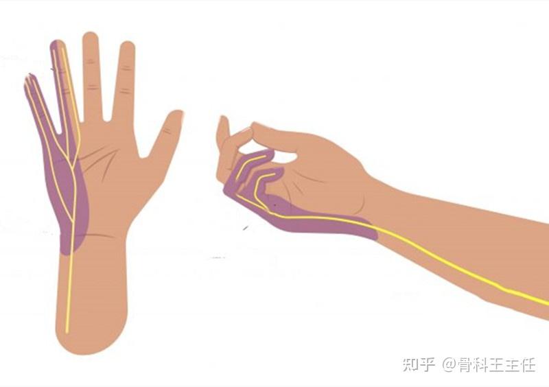 手指和手臂发麻，一直反反复复，最可能是这3种疾病 - 知乎