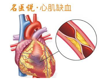 心肌缺血是什么病?