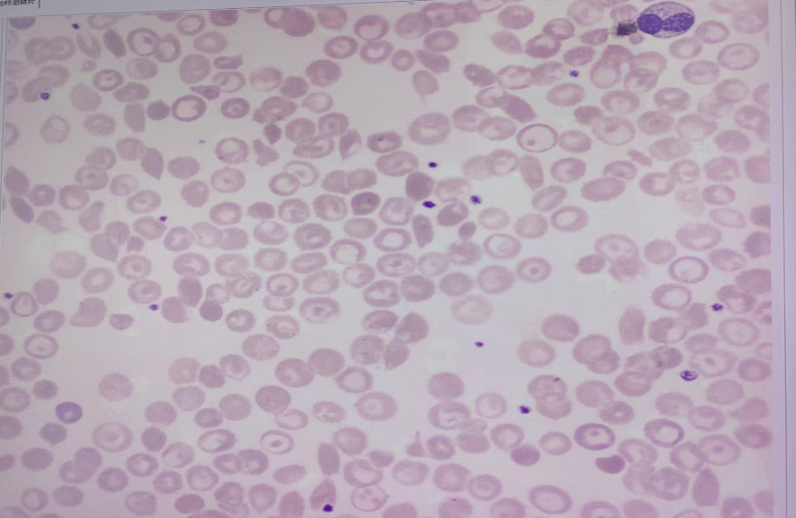 一例罕见的有核红细胞升高的病例 - 知乎