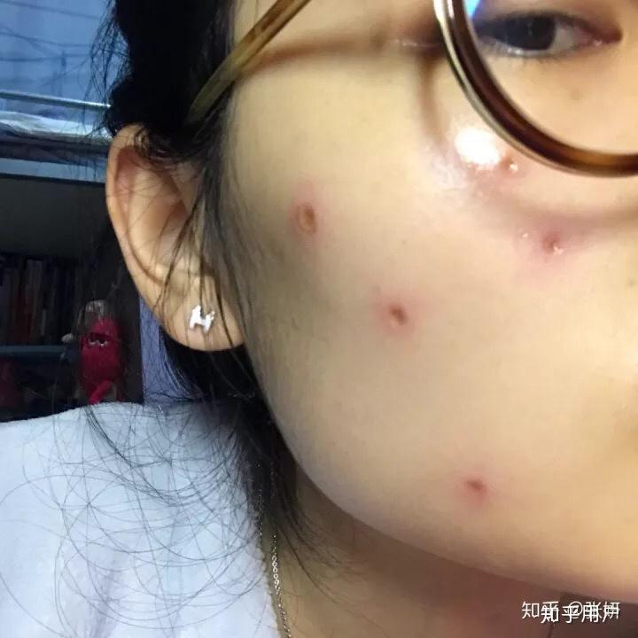 点痣成功与否会受季节影响吗