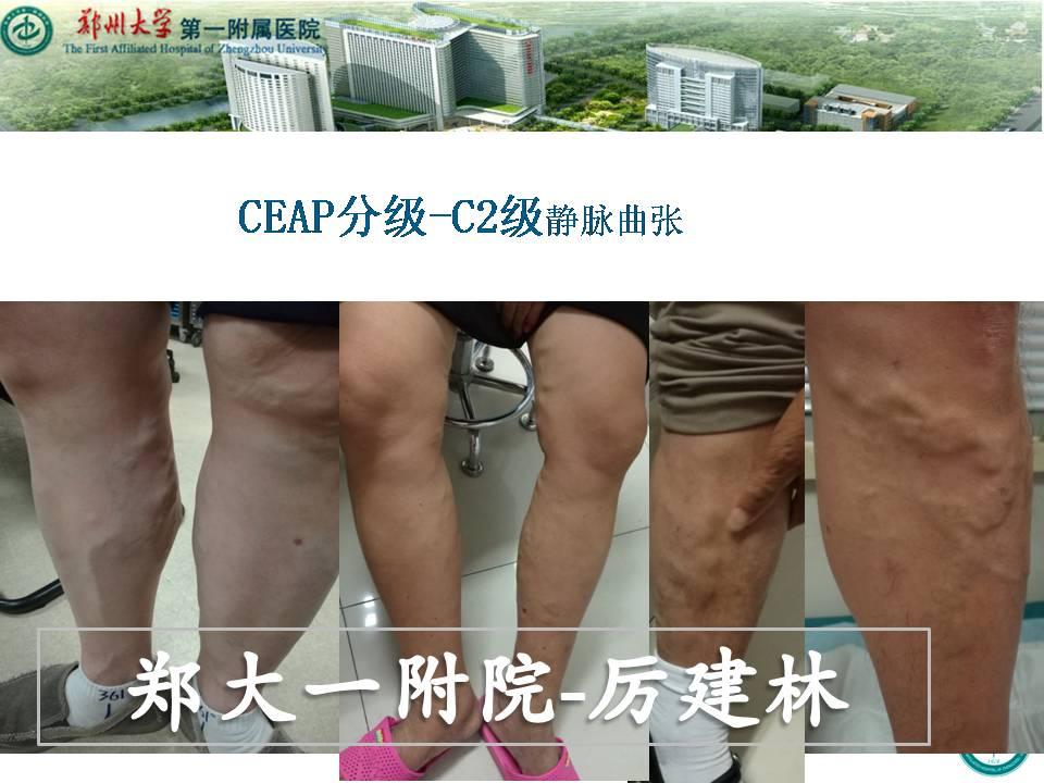 下肢静脉曲张CEAP分级 - 知乎