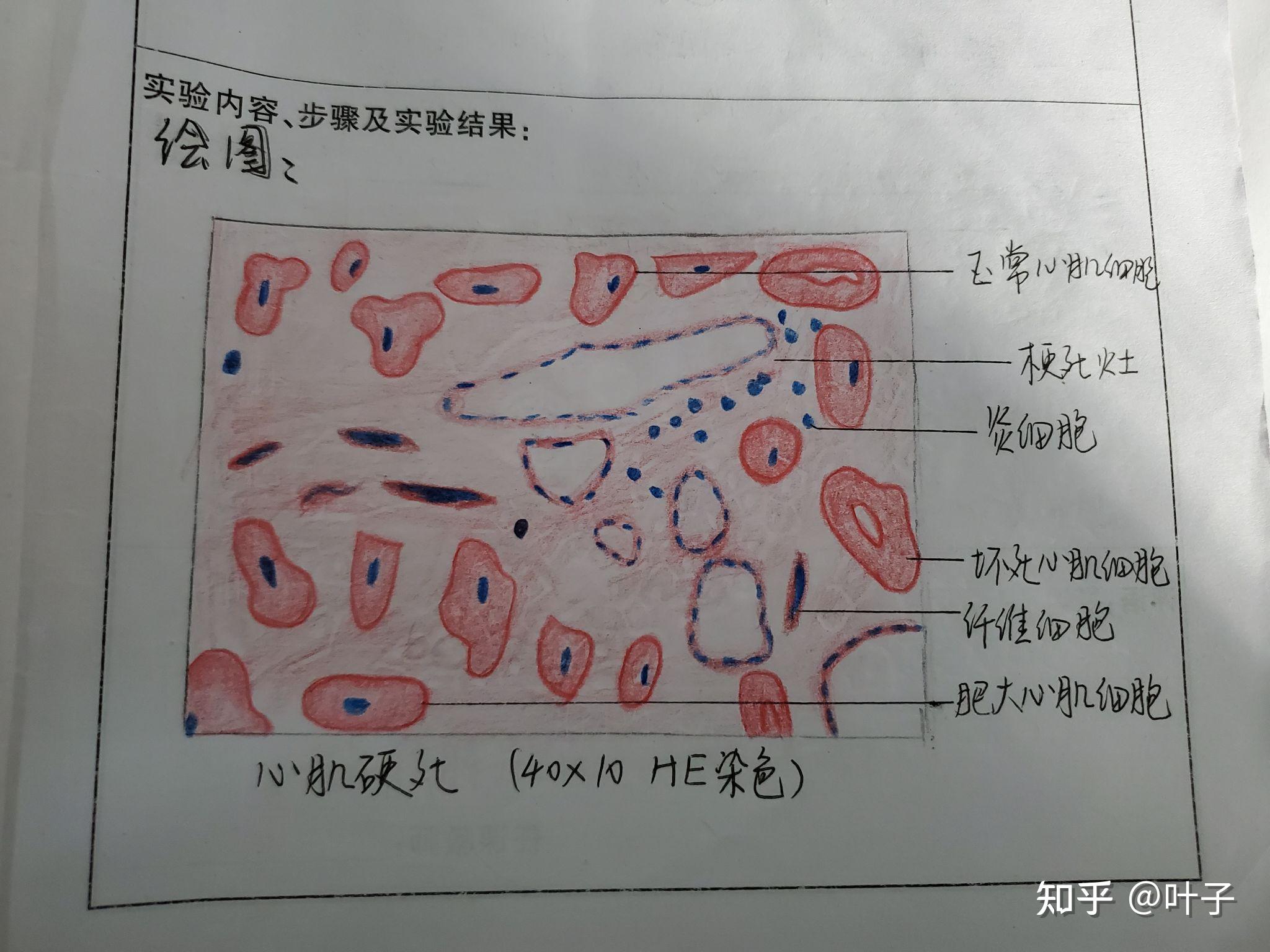 求有沒有脾梗死心肌梗死病理學繪圖