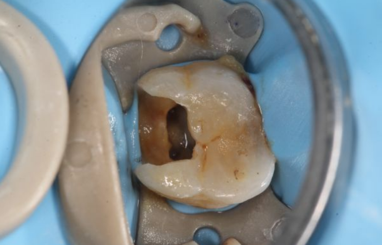 根管治疗后带牙冠的过程疼吗