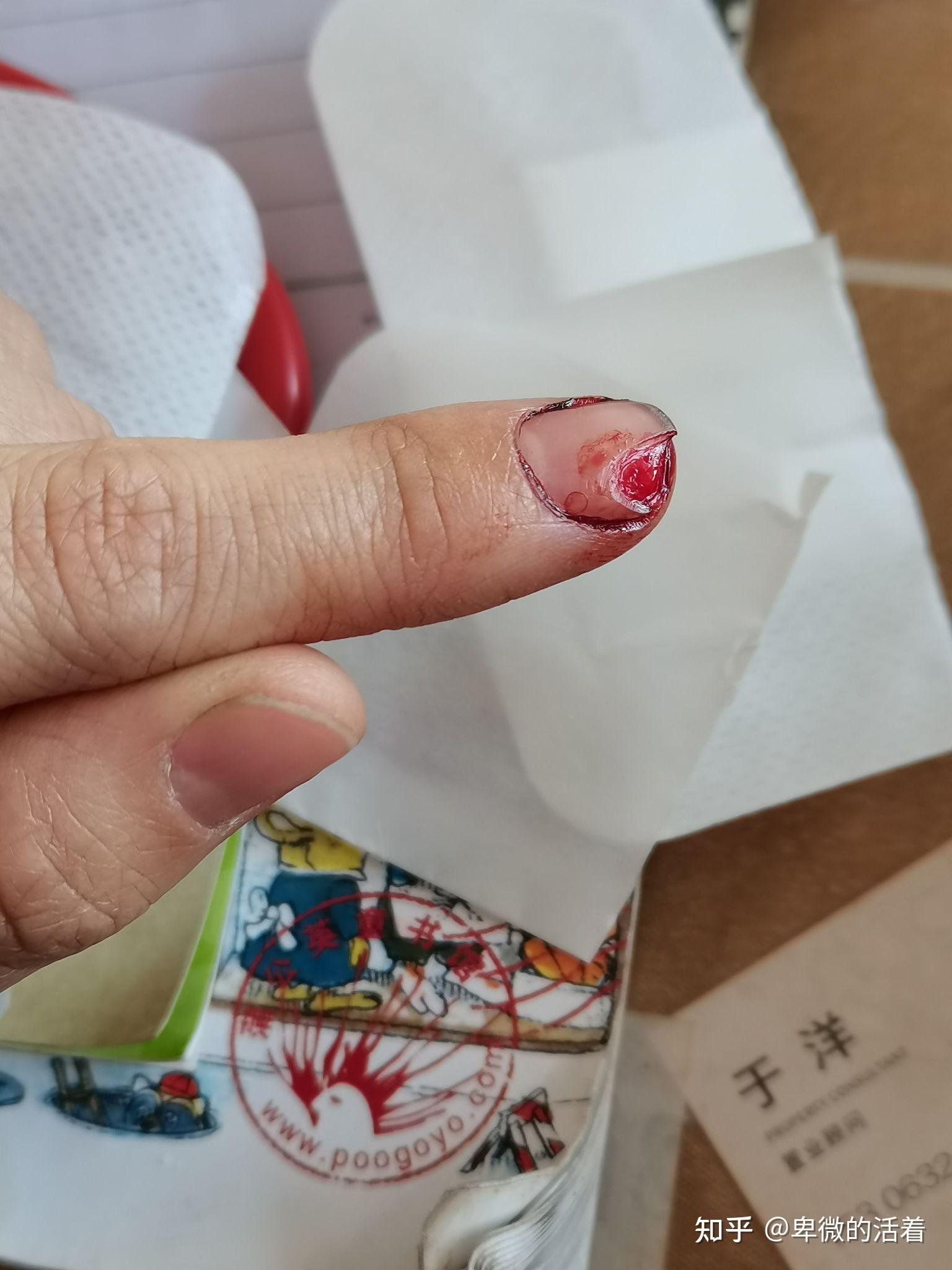 指甲断了还能长出来吗