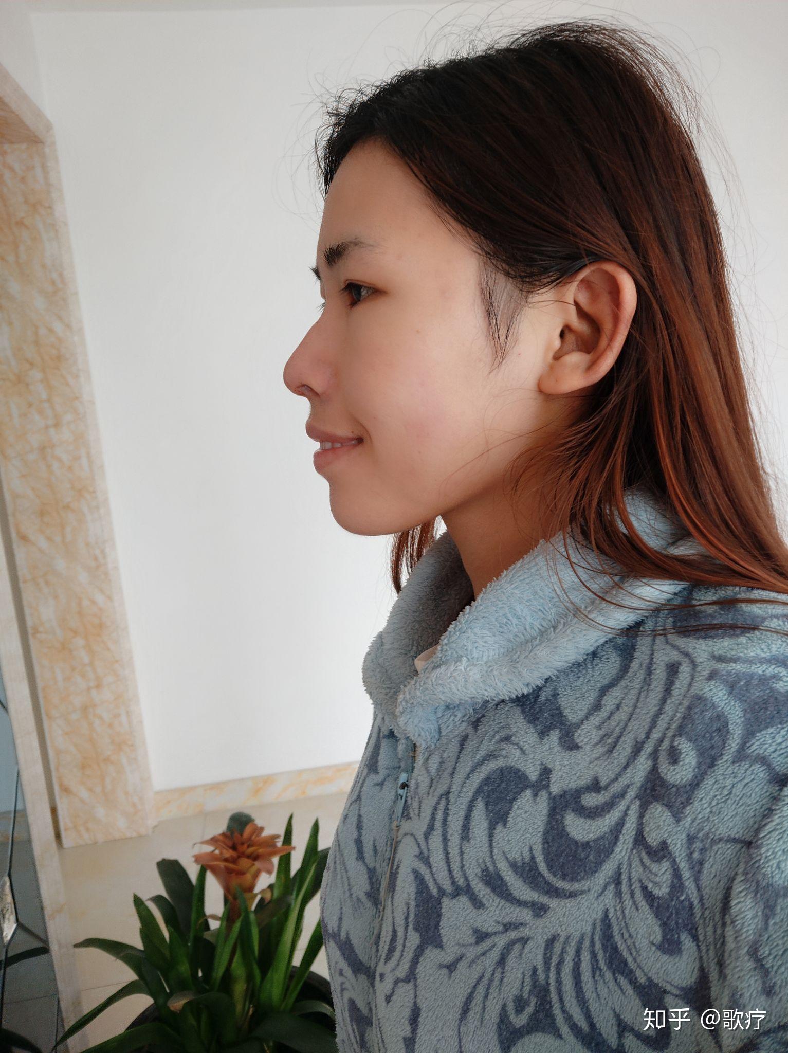 龅牙凸嘴怎么改善侧脸? - 知乎