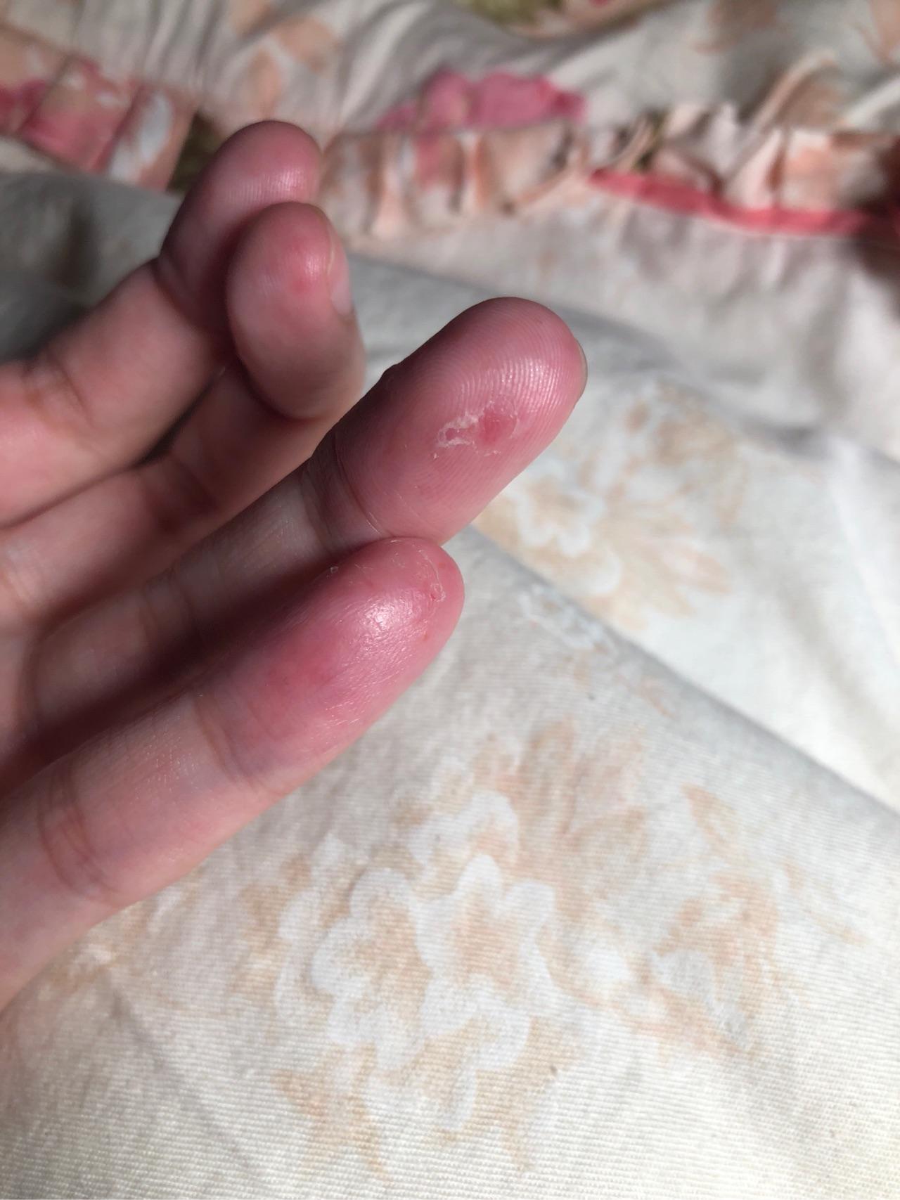 可以帮忙看一下冬天手脱皮怎么办吗?谢谢～? - 知乎