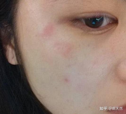 脸上长了很多小疹子,眼睛看不出,摸上去很明显,怎么办? - 知乎