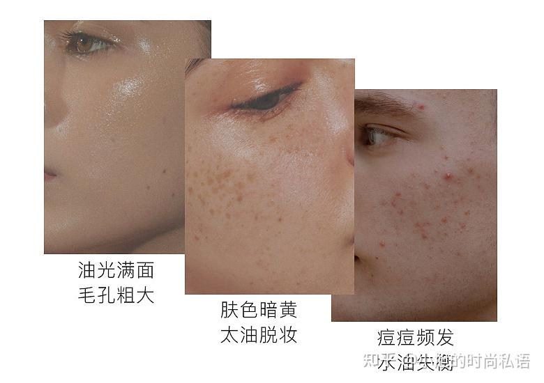 油敏肌夏季该如何护理？ - 知乎