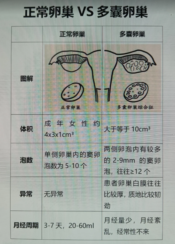 反复长痘可能是多囊卵巢综合征!你最需要了解的治疗方法!
