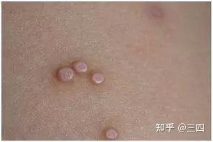 疣体,不见得就是性病哦。 - 知乎
