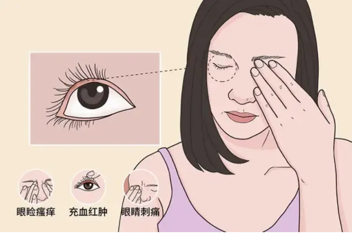 干眼睑缘炎综合征（DEBS）：睑缘炎，生物膜与干眼症 - 知乎