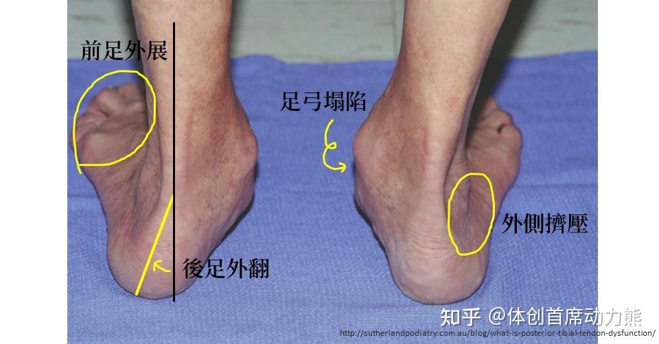 后天性足弓塌陷可以恢复吗怎么恢复