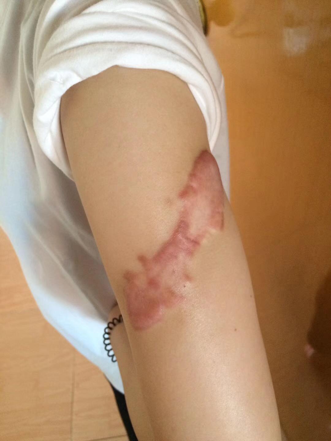 瘢痕体质的人这一生有什么样的体验? - 知乎