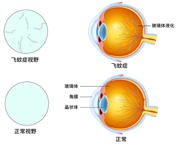 你们的飞蚊症是怎么开始的