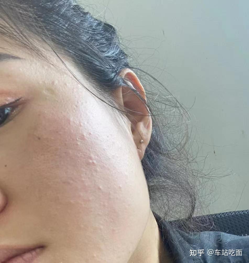 闭口冒白头怎么办? - 知乎