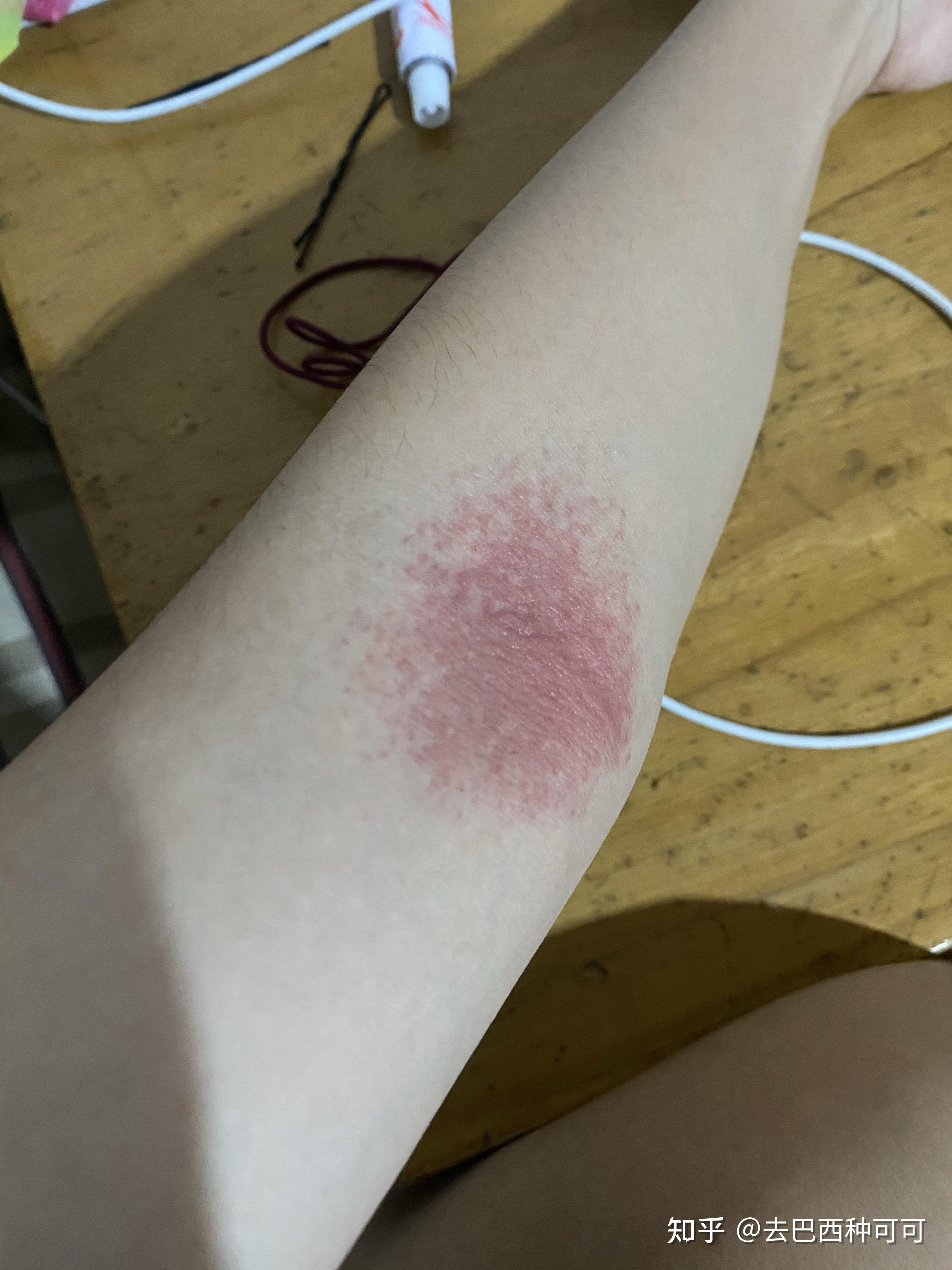 拍打手肘窝真的可以排毒吗