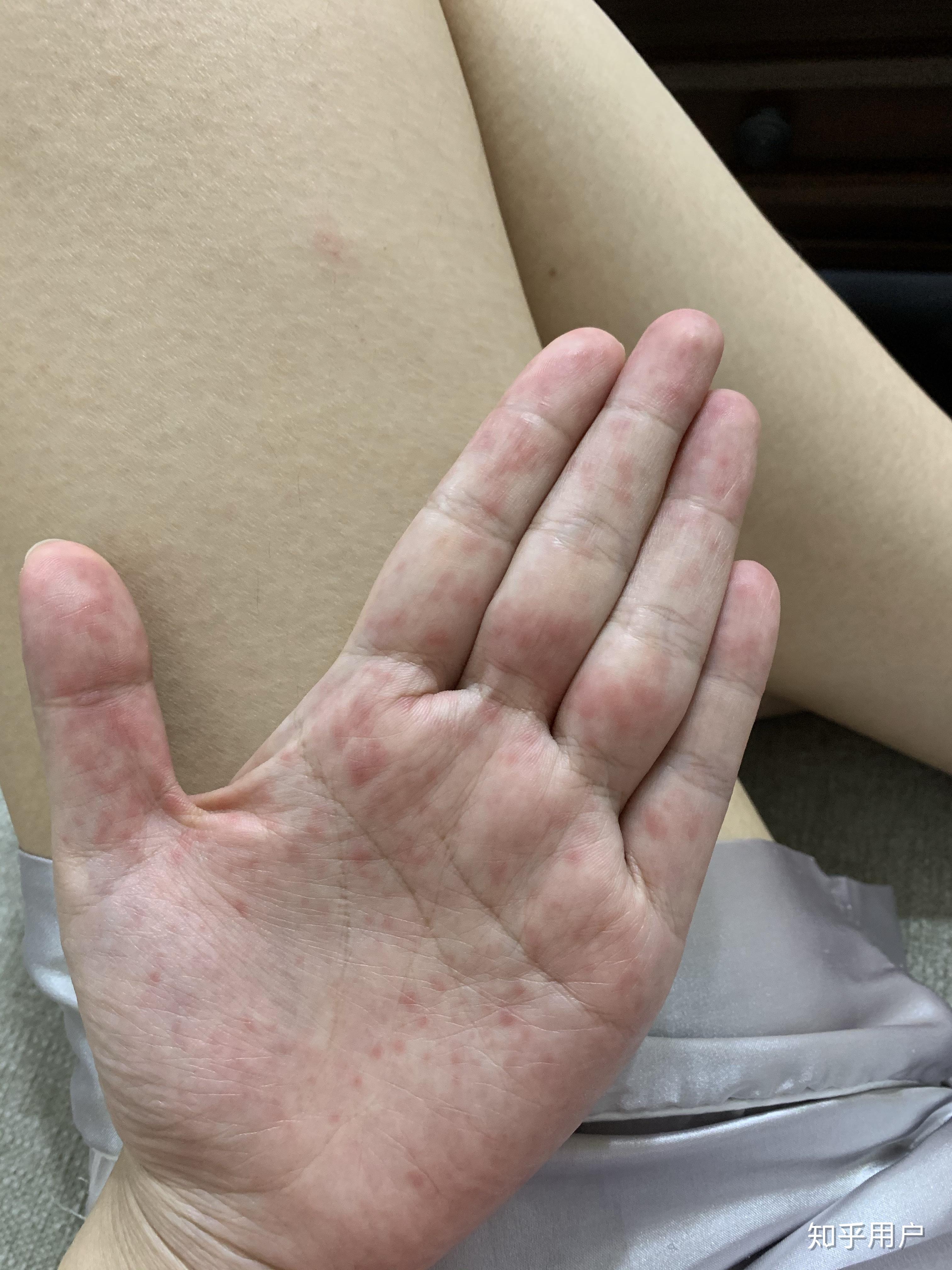 成年人得手足口病什么感觉