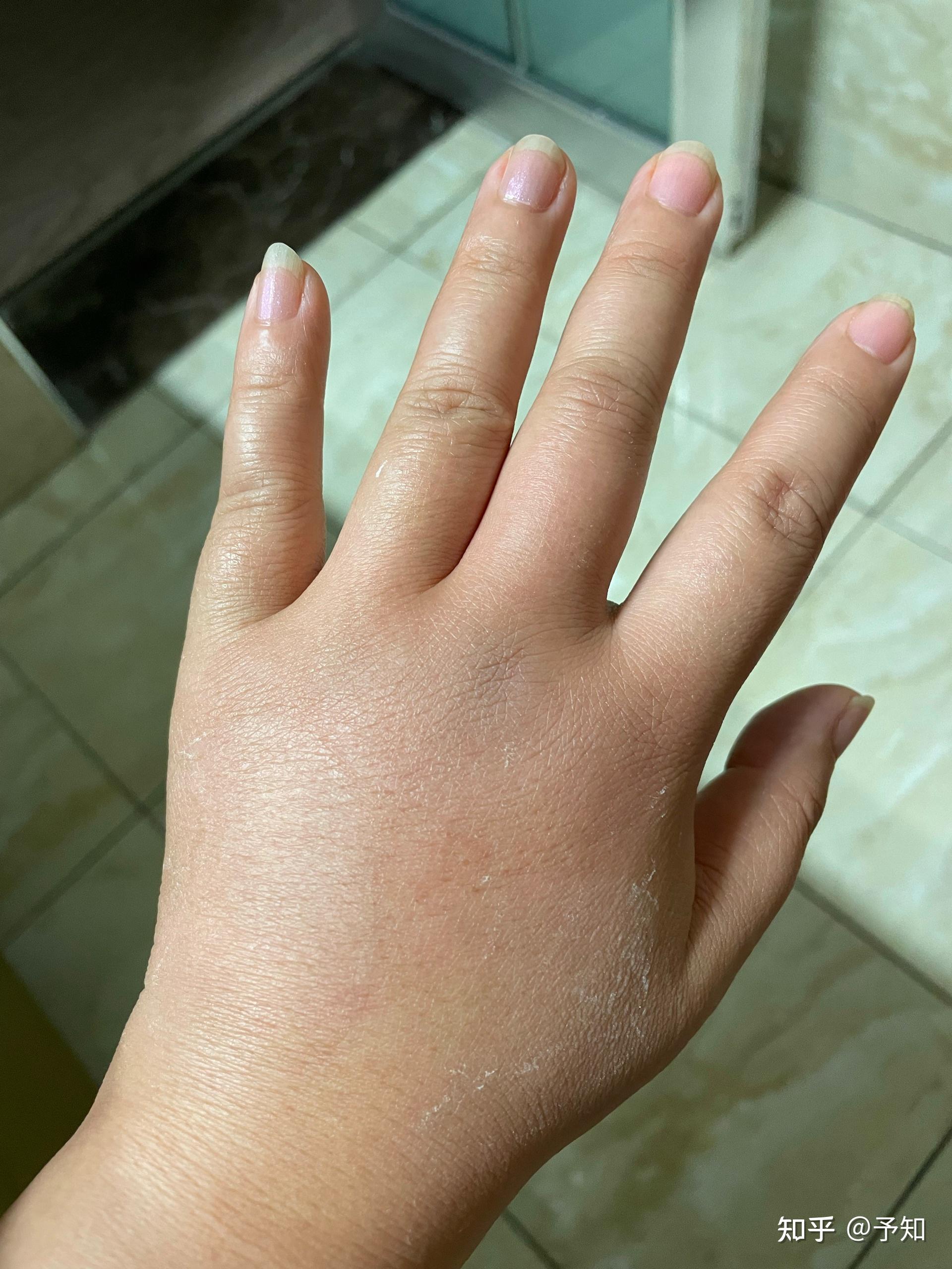 手被蚊子咬了啊啊啊啊,肿成了猪肘子啊啊啊,怎么办啊啊啊(21_21)?