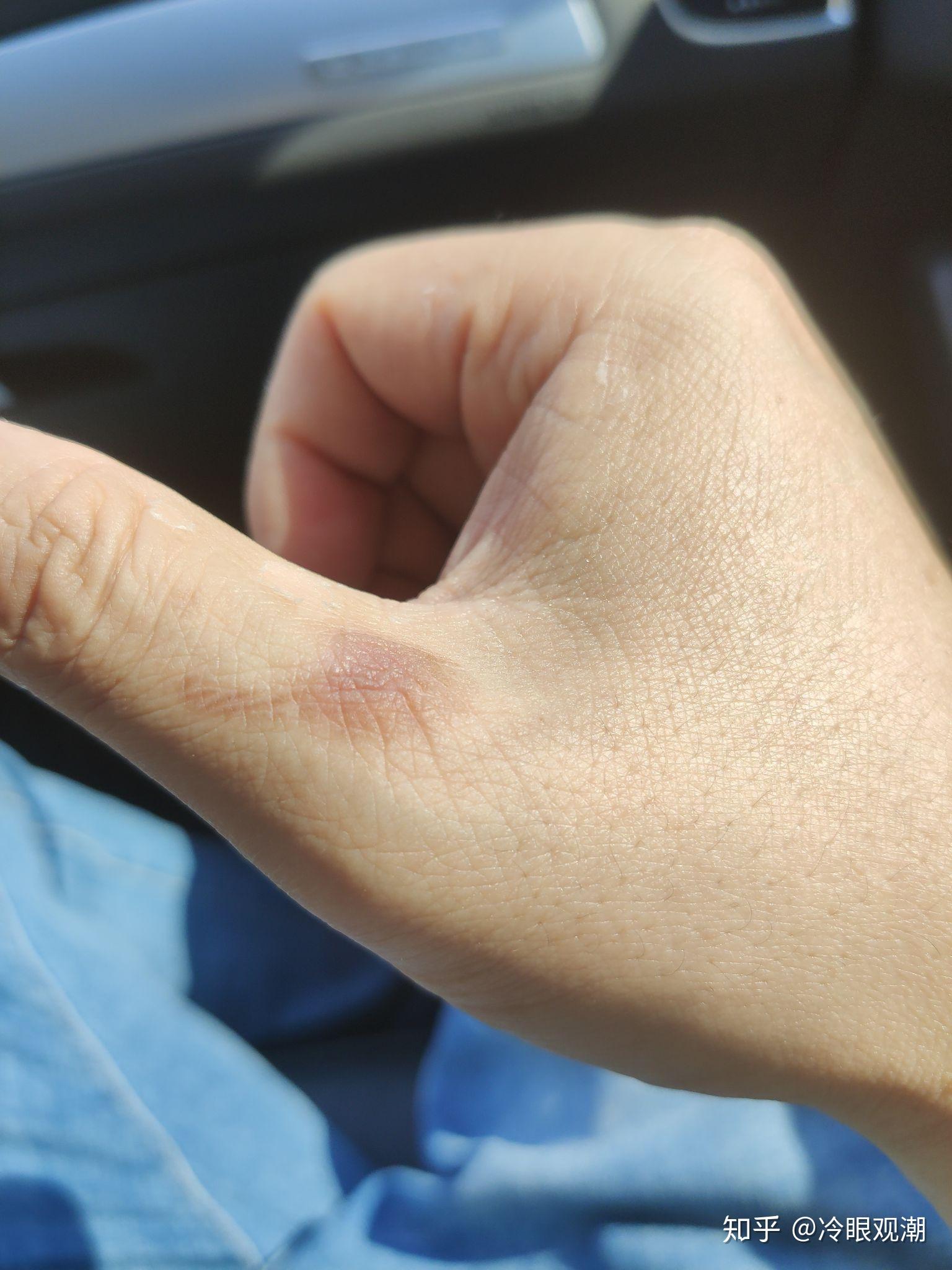 手烫伤了怎么办,起泡了? - 知乎