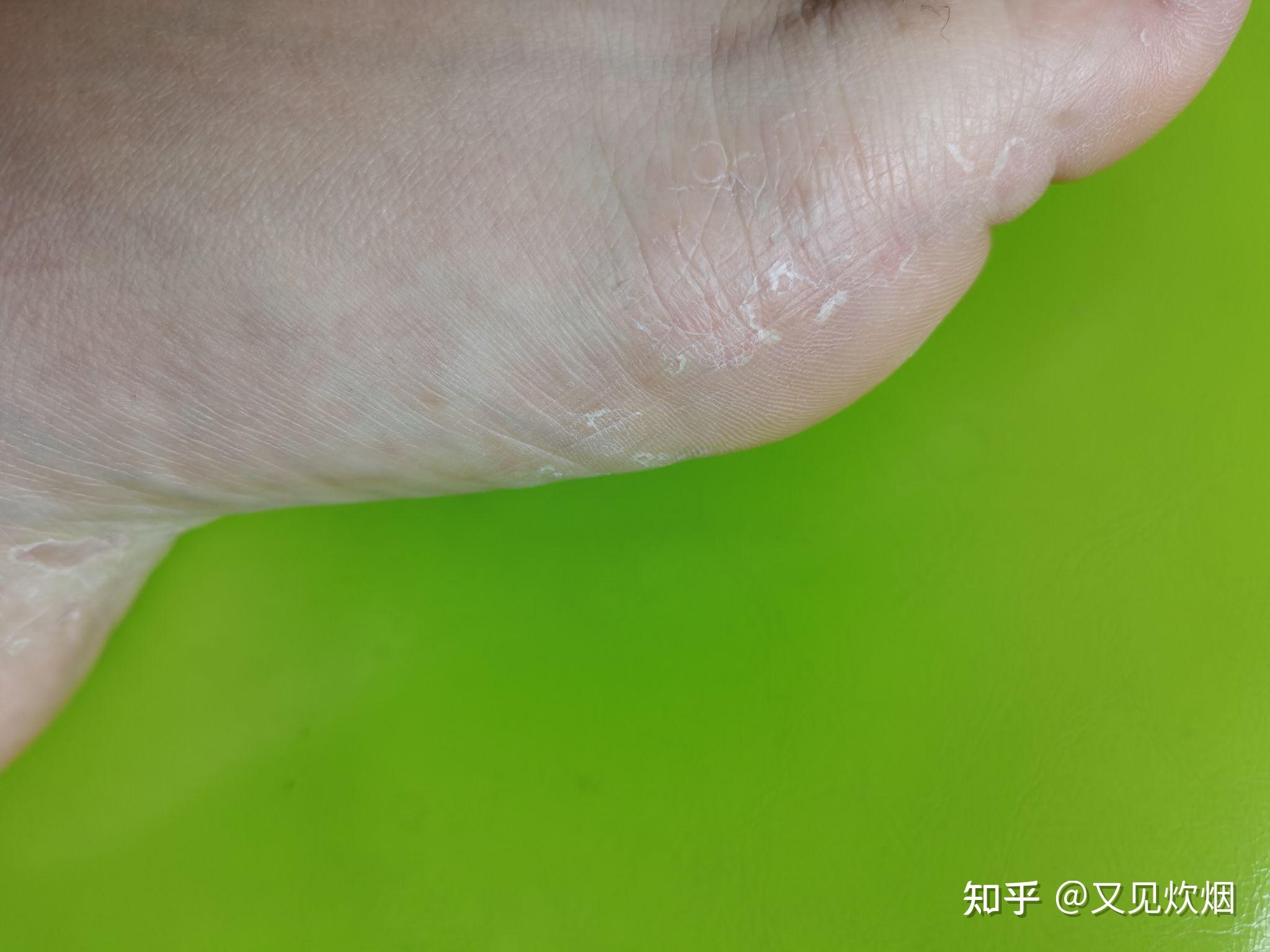 水疱型脚气水泡能扎破吗