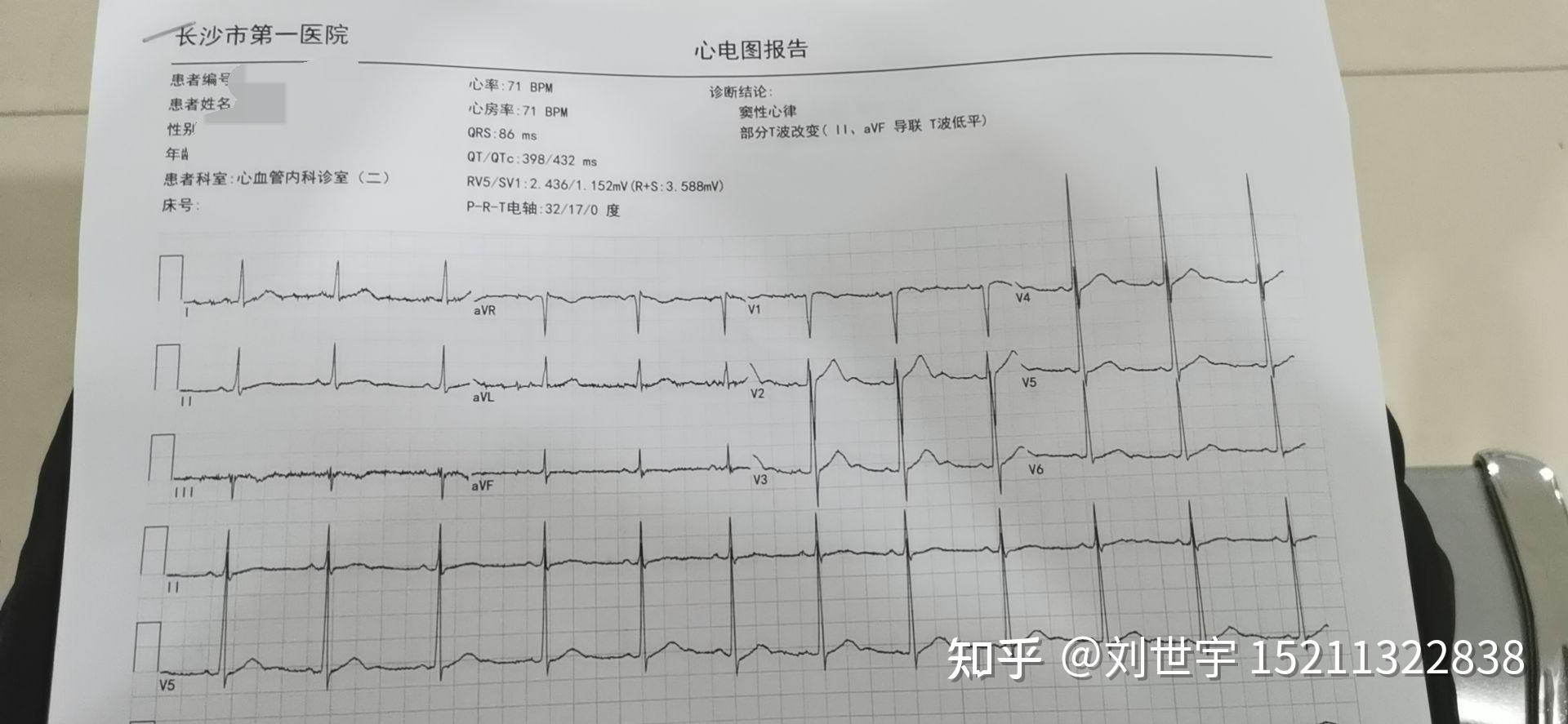 心电图t波低平