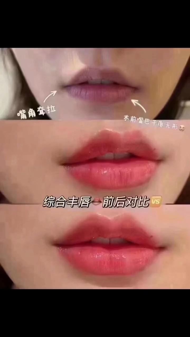 嘟嘟唇操作前后对比甜美优雅气质此种唇形财气旺盛一生衣食无忧仕途
