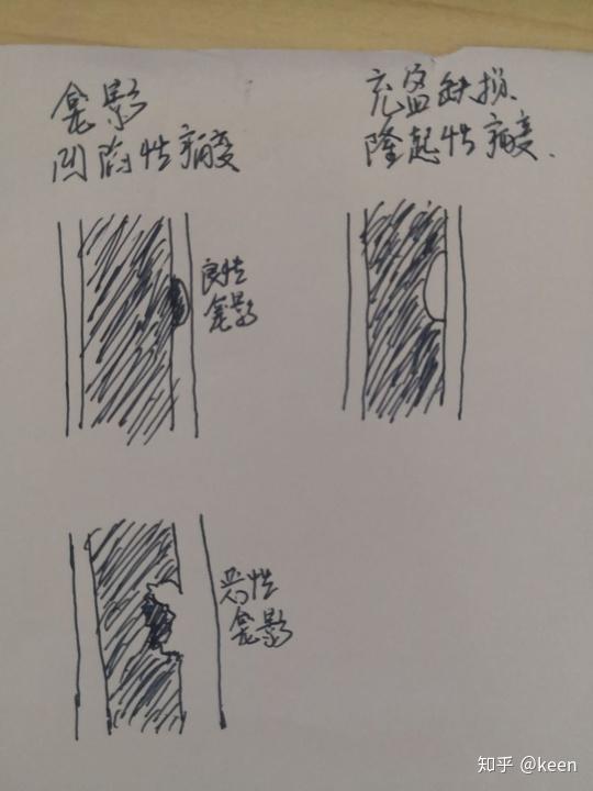 恶性龛影和充盈缺损都是向内凹陷的那它们怎么区别呢