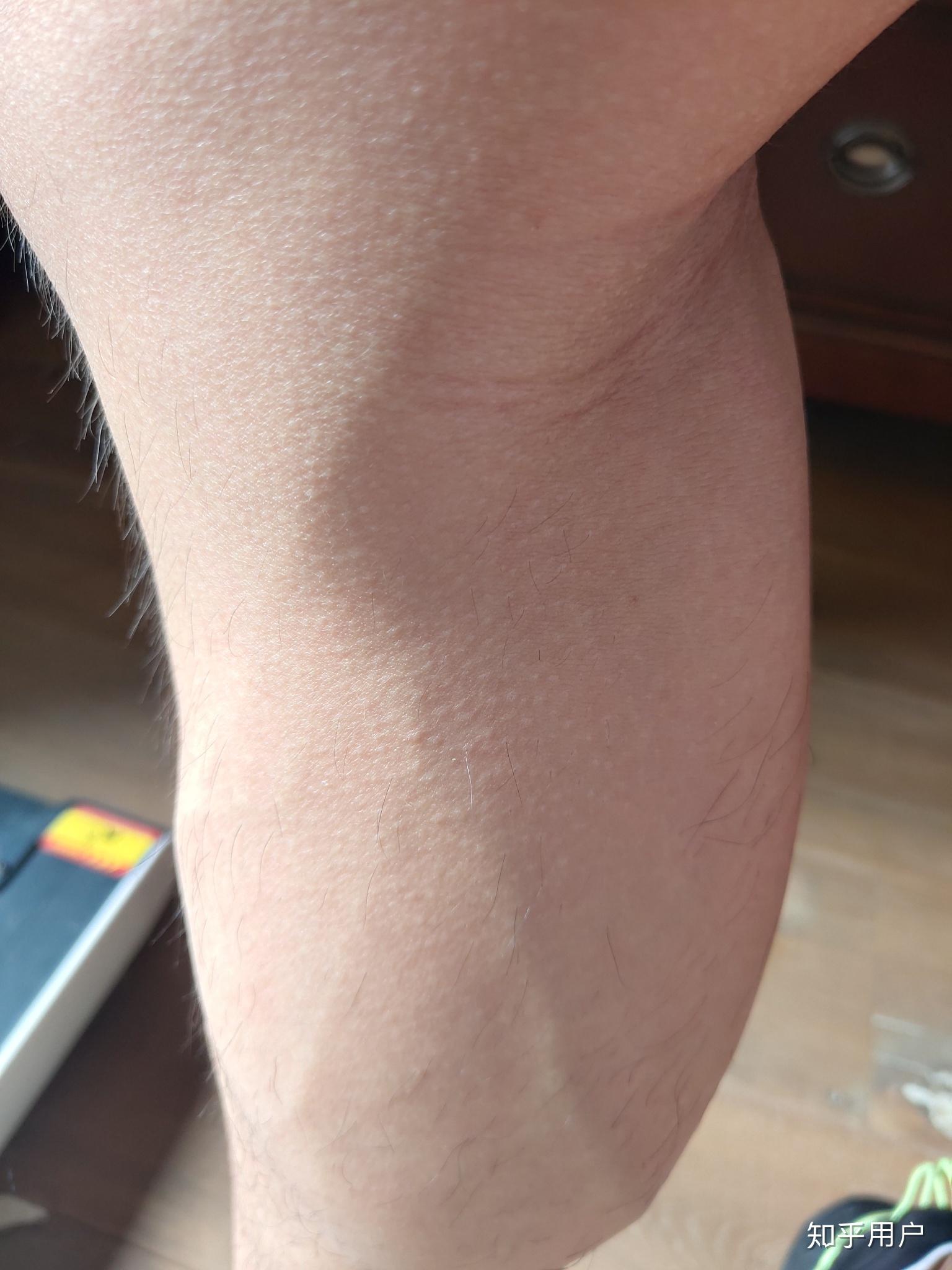 为何大腿外侧毛细血管这么明显