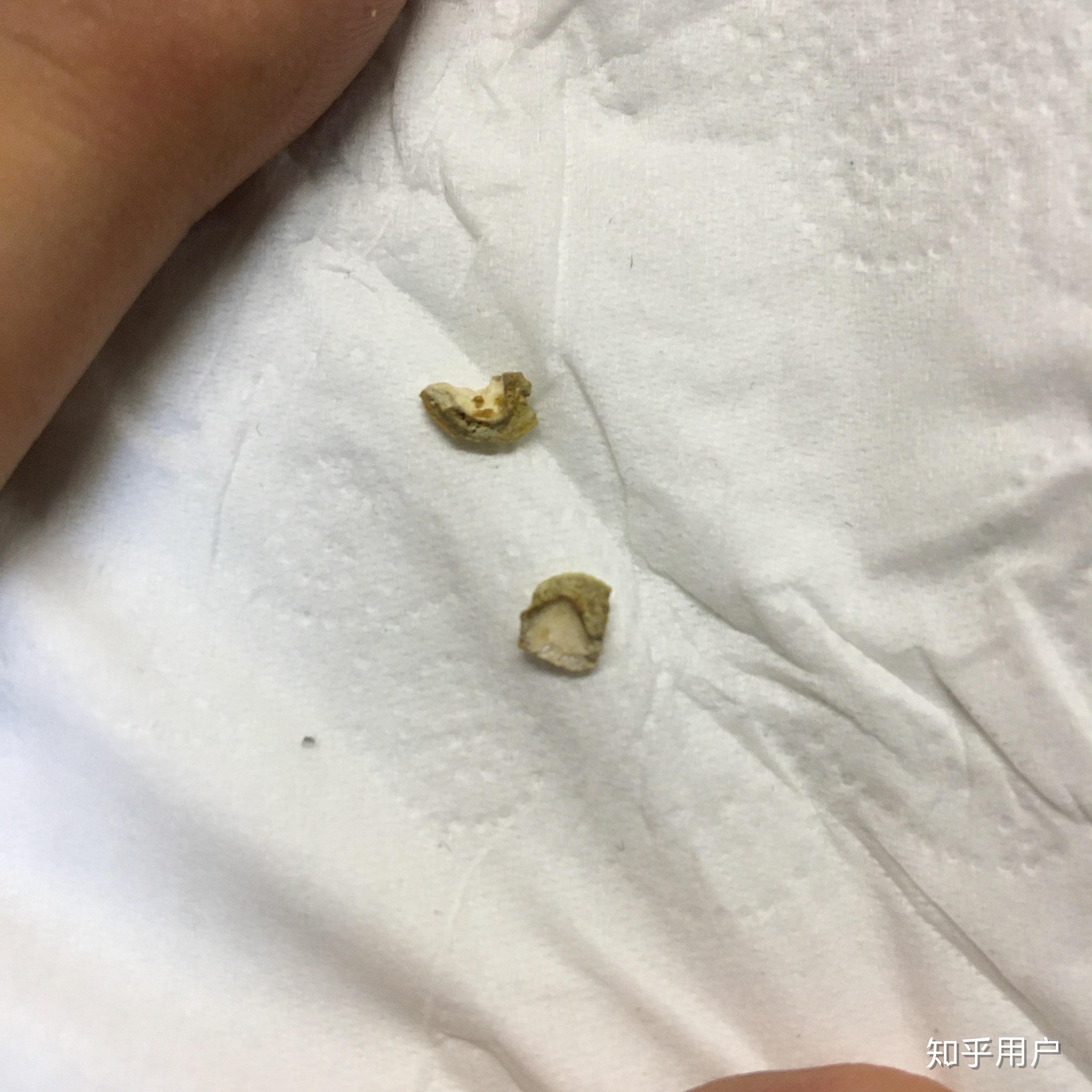 牙结石长什么样