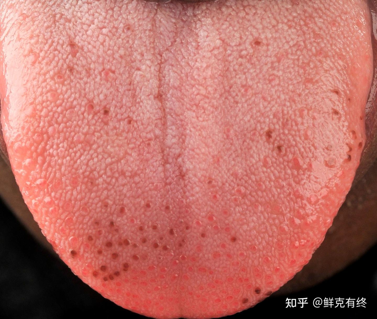 “尖锐湿疣”or“口腔癌”？No！来认识一下那些易被误解的正常口腔结构！（一） - 知乎