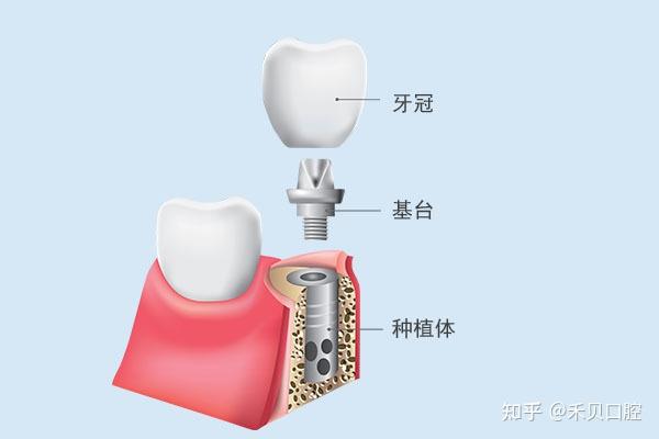 牙列缺损是什么?如何修复牙列缺损? - 知乎