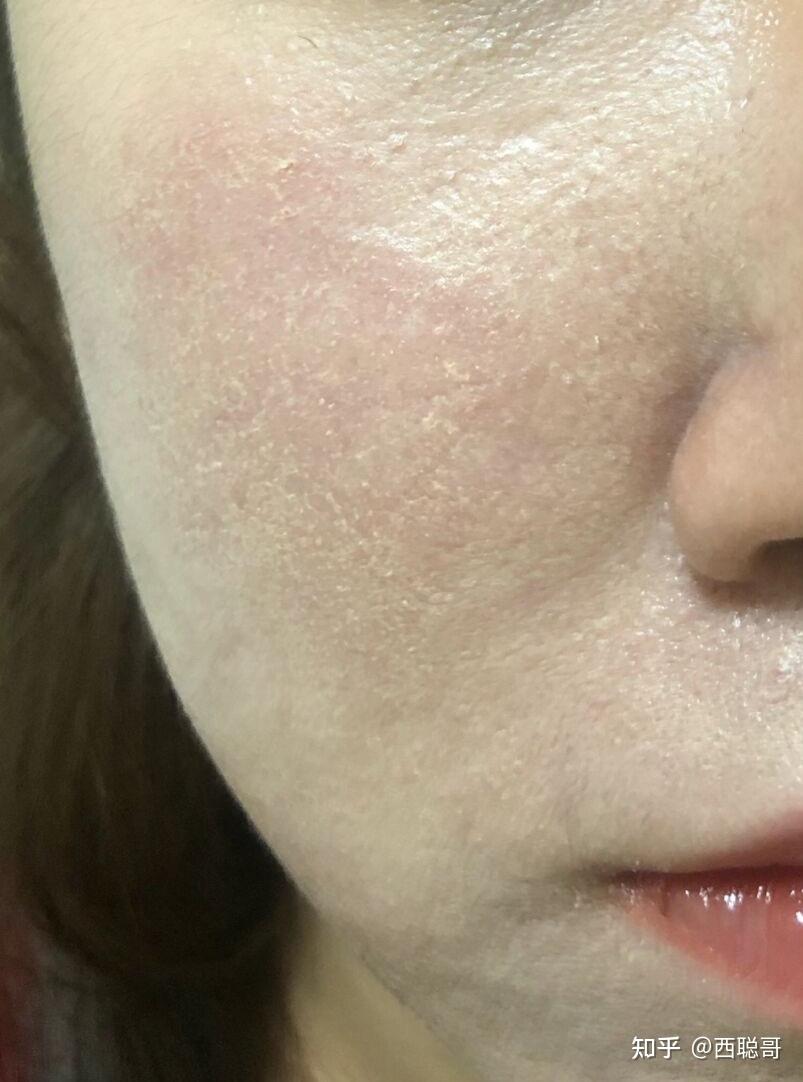 混油皮超级卡粉起皮浮粉怎么办有无护肤品推荐