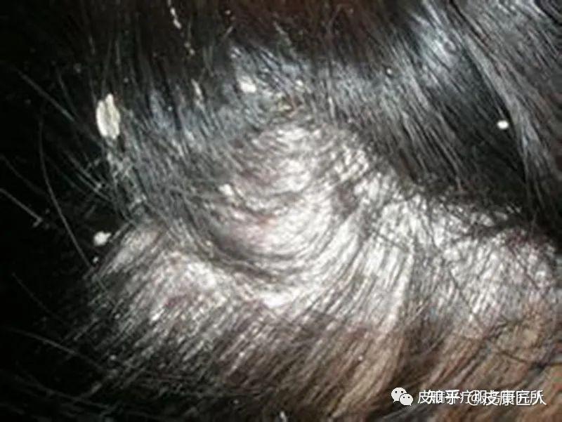 脂溢性皮炎的简单判定 - 知乎