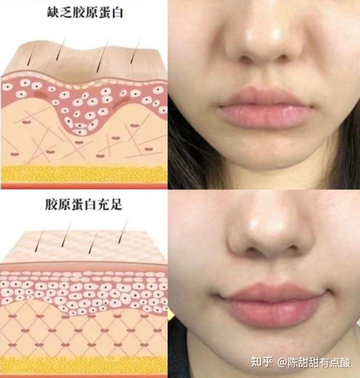 实测打卡2个月去法令纹后续!皮肤科医生推荐的抗老精华淡纹紧致真的有效? - 知乎
