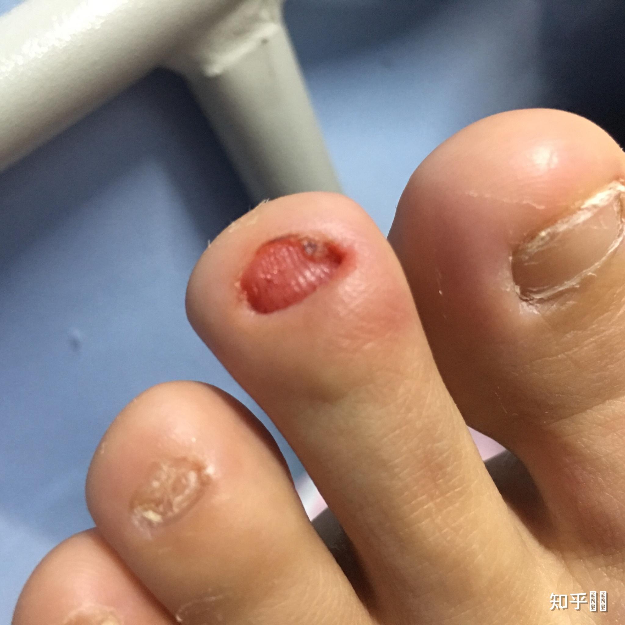 整块指甲抠得基本不剩了这样指甲能不能再长好呢