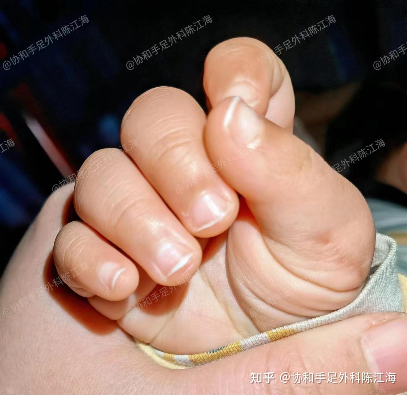 我第一胎男孩身体正常,第二胎宝宝有"六指",该怎么给四岁的哥哥解释