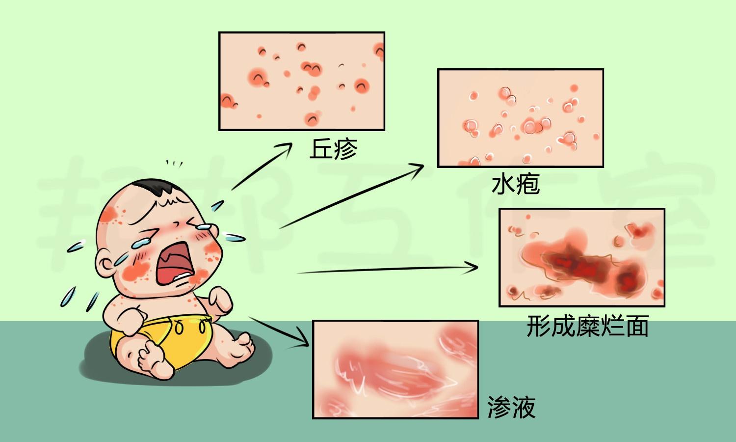 婴儿发湿疹的原因（婴儿得了湿疹很麻烦）-幼儿百科-魔术铺