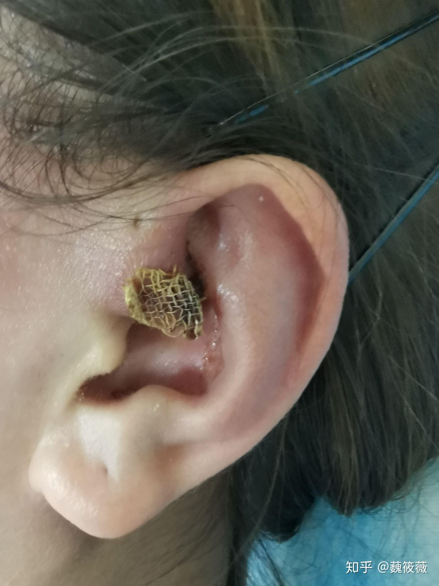 患有先天性耳前瘘管是一种怎样的体验