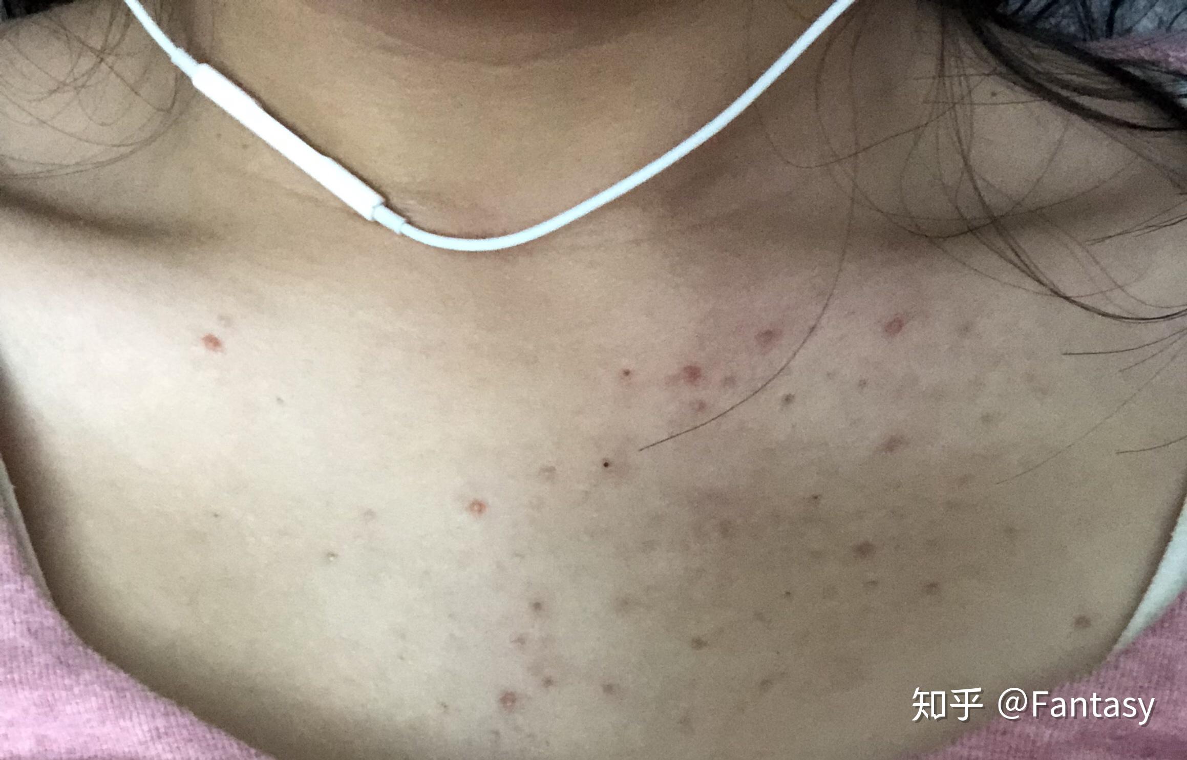 胸前和背上长的是痘痘还是毛囊炎? - 知乎