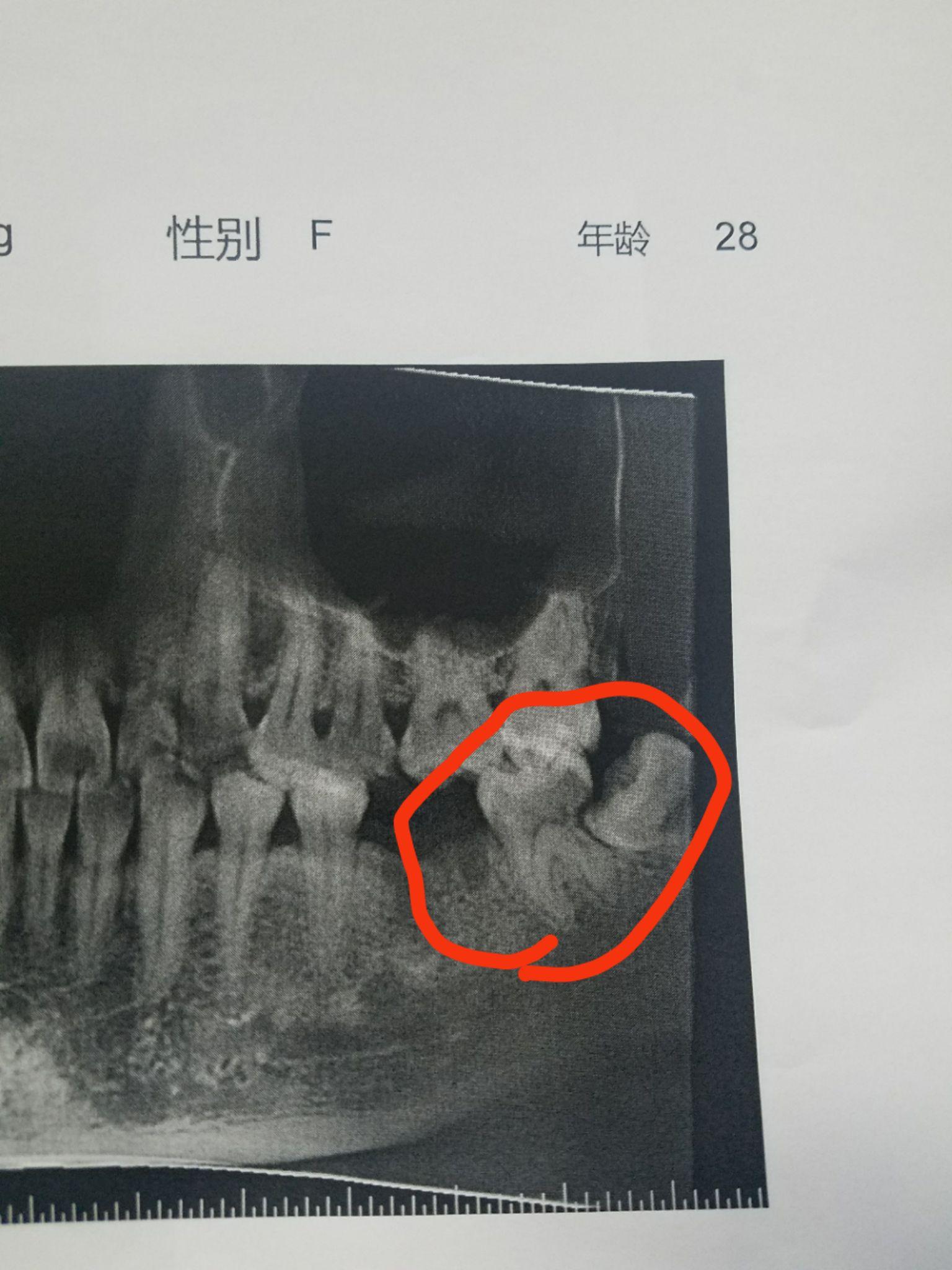 我这个横向智齿难度大不大疼不疼费用大概多少