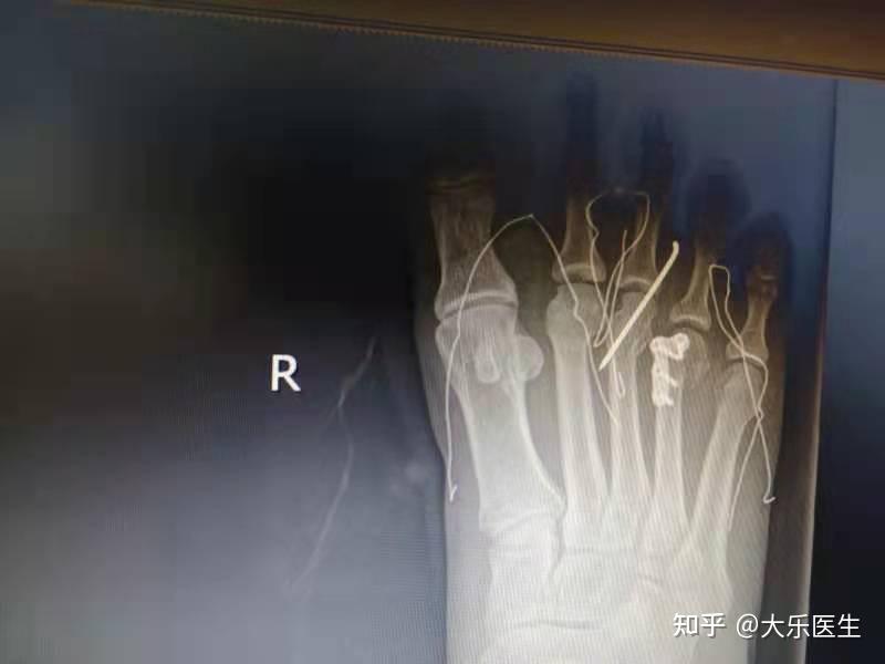 左脚大拇指骨折三个月了现在还不会弯曲是什么原因造成的? 