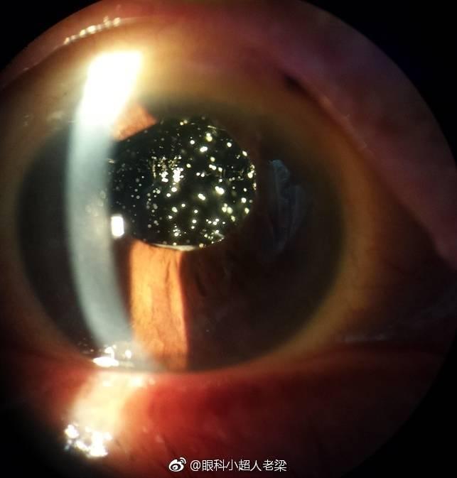 玻璃体变性引起的玻璃体混浊出现的飞蚊症能好吗