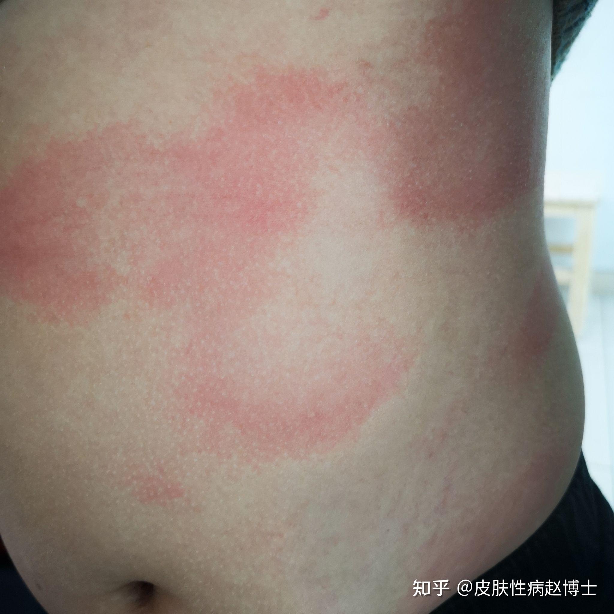 身上起了一大块的红片医生说是风团风团是什么