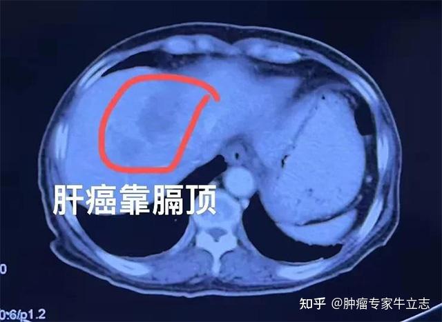肝癌四期怎么治疗?