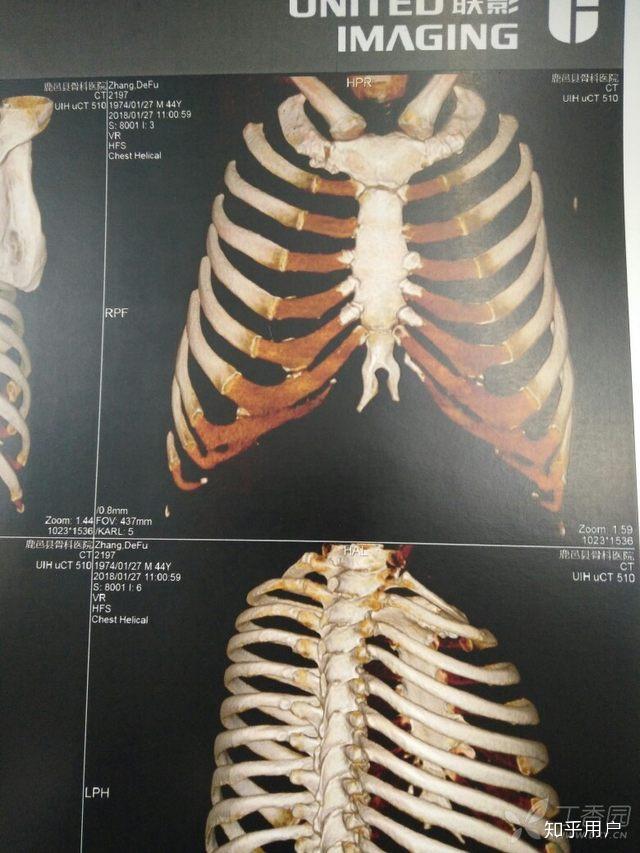 胸骨剑突突出图片