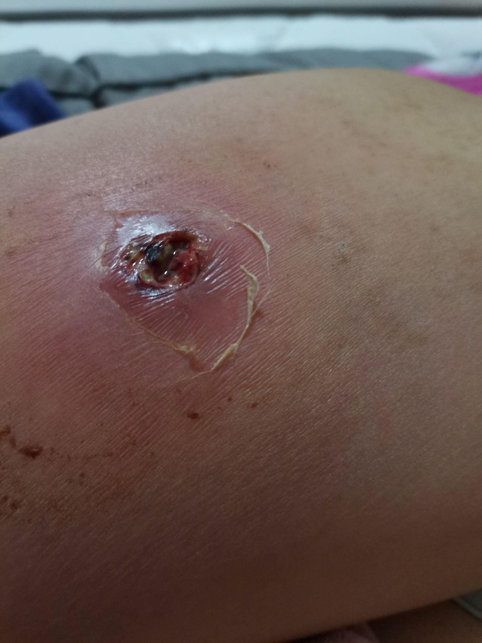 蜂窝组织炎与脓肿的区别?