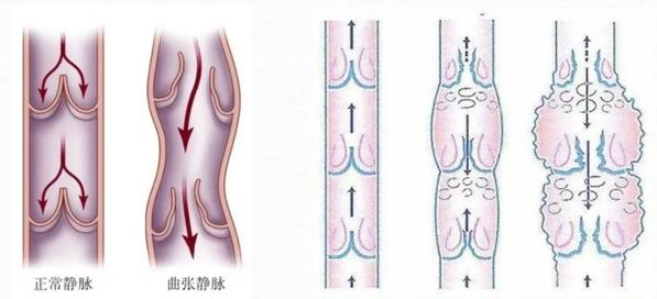 胸壁静脉曲张常见于图片