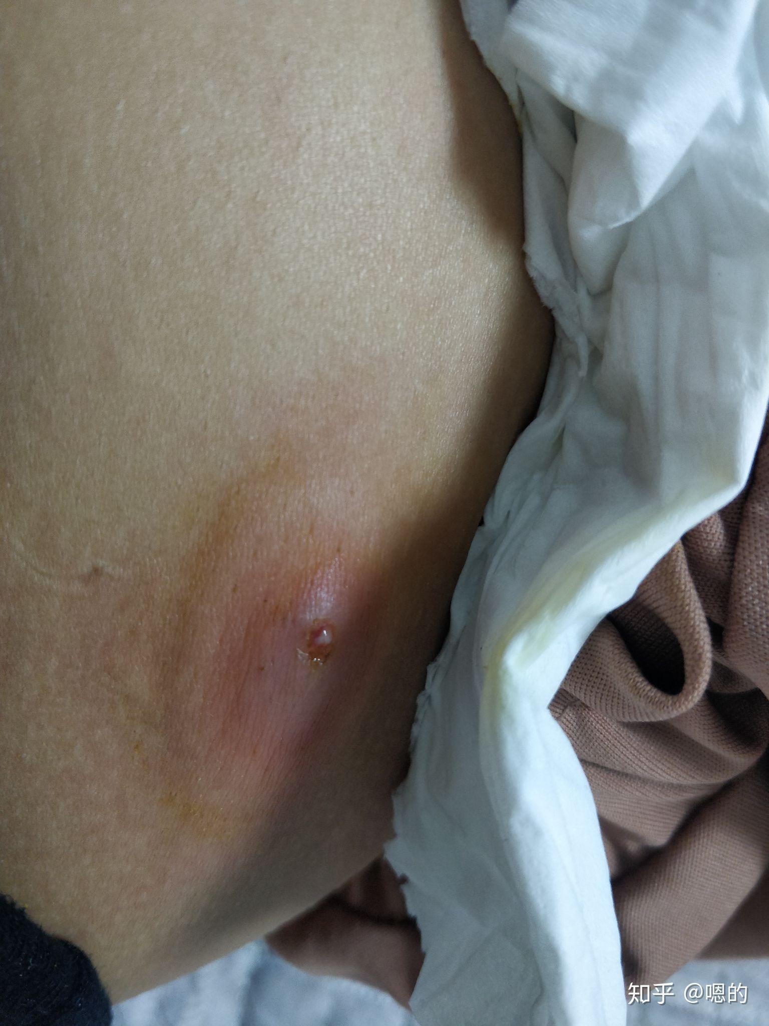 一个火疖子能大到什么地步? - 知乎